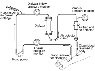 https://b11nk.files.wordpress.com/2009/04/hemodialysis_schematic.gif?w=444